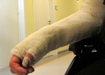 Złamana ręka, gips, ortopedia / Robert Felczak / Radio Kielce