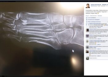 Złamana stopa Justyny Kowalczyk Soczi 2014 / Facebook