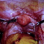 Pierwsze ogólnopolskie warsztaty laparoskopii ginekologicznej dla młodych ginekologów onkologów w Świętokrzyskim Centrum Onkologii. Zabieg ginekologiczny / Marzena Mąkosa / Radio Kielce