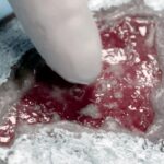 Larwoterapię, czyli metodę oczyszczania trudno gojących ran, stosuje się w przypadku leczenia ran przewlekłych lub przebiegających z zakażeniem, np. przy stopie cukrzycowej / azmed.com.pl