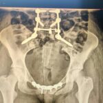 Kielce. Skomplikowany zabieg połączenia kręgosłupa z miednicą i zespolenia miednicy w Wojewódzkim Szpitalu Zespolonym w Kielcach / Fot. Wojewódzki Szpital Zespolony w Kielcach - Radio Kielce