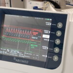 Zabieg pompą Impella. Fot. Szpital w Starachowicach