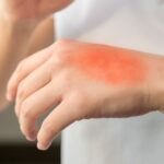 Co zrobić w przypadku oparzenia (2)