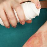 Co zrobić w przypadku oparzenia / źródło: canva.com