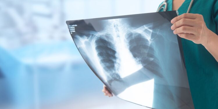 Nauczycielka z gruźlicą, uczniowie do diagnozy