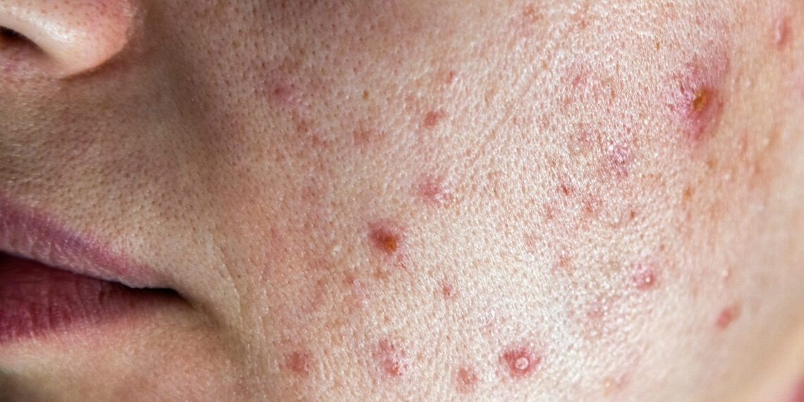 Po wakacjach warto sprawdzić nowe zmiany na skórze